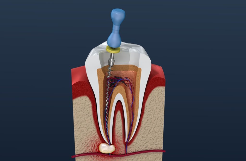 Root Canal Treatment