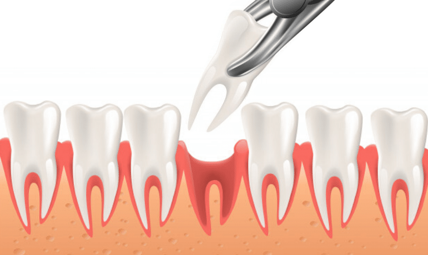 Painless Tooth Extraction